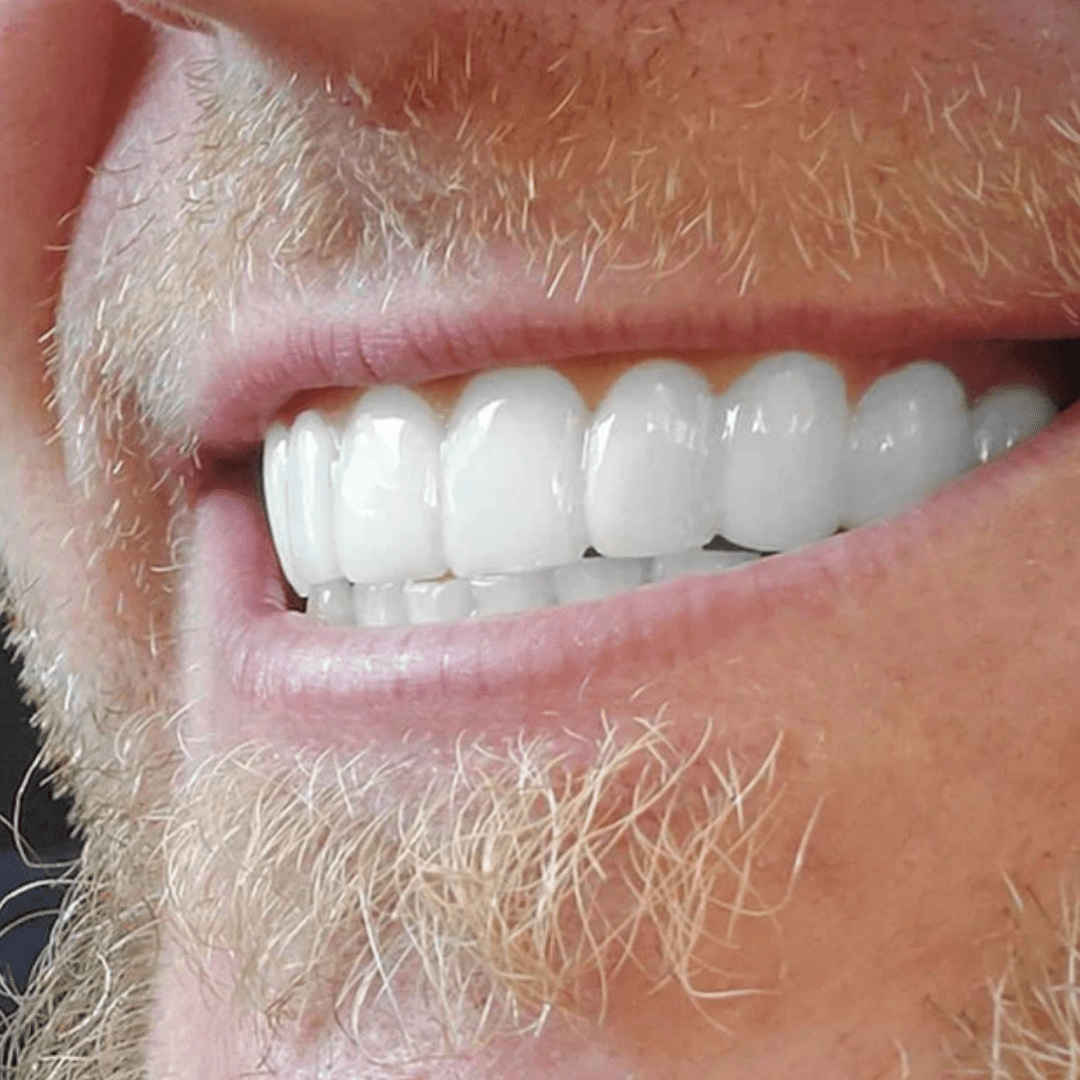 EasySmile | Carillas dentales de cerámica adaptables - GoMart!